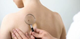 Skin Cancer Check Why to Use Sunscreen and How to Check Moles for Skin Cancer Signs